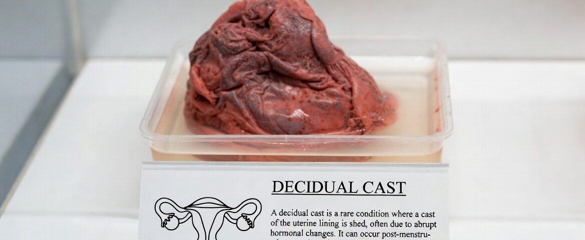 decidual cast