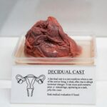 decidual cast